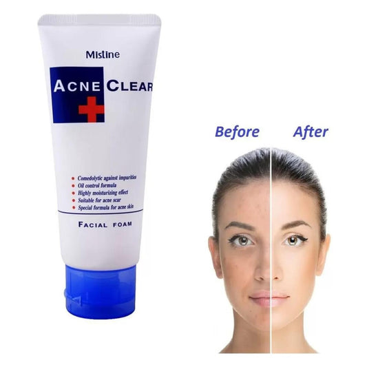 Acne Control Face Wash – Deep Cleansing & Oil Control for Clear Skin