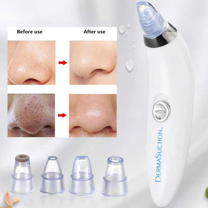 Derma Suction 4-in-1 Blackhead Remover – Pore Cleaner Vacuum with 4 Suction Heads - Free Delivery